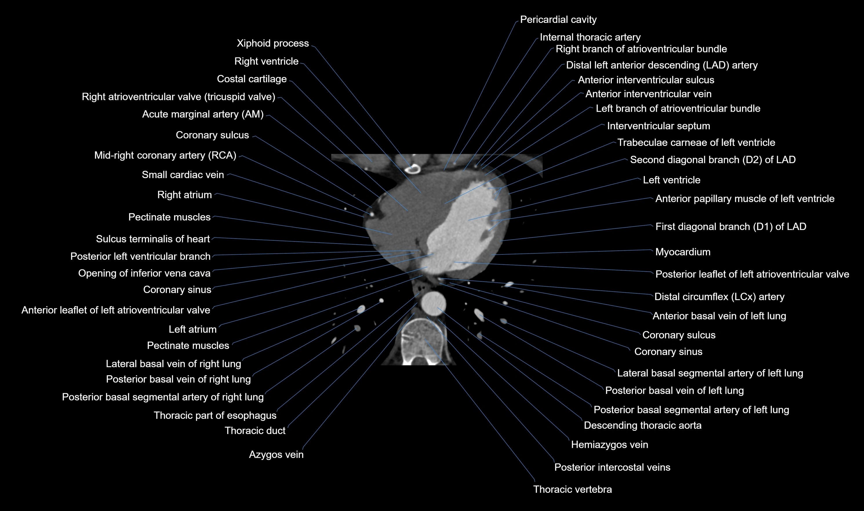 CT heart (coronary angiogram) axial view cross sectional anatomy labelled radiology image-00047.webp